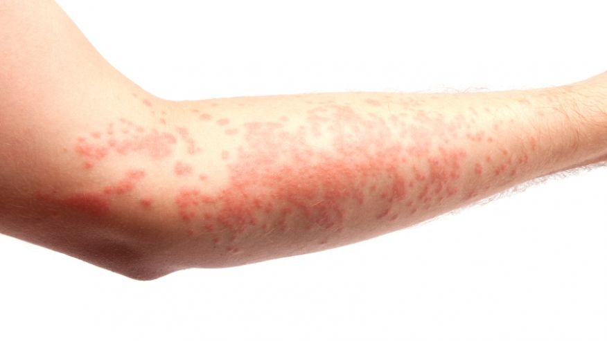 skin_allergy